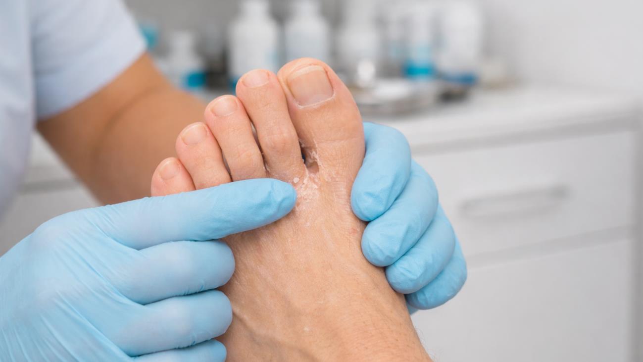 Stop It from Spreading between the toes