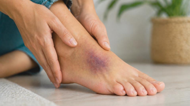 Bruise on top of foot with hand touching painful area