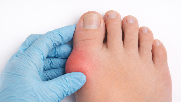 close-up of bunion on big toe joint examined by a podiatrist