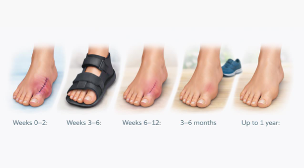 how long to recover from bunion surgery