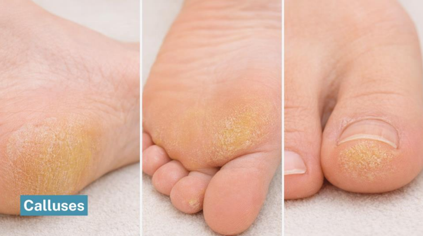Examples of foot calluses showing thick yellow skin on heel, ball, and toe