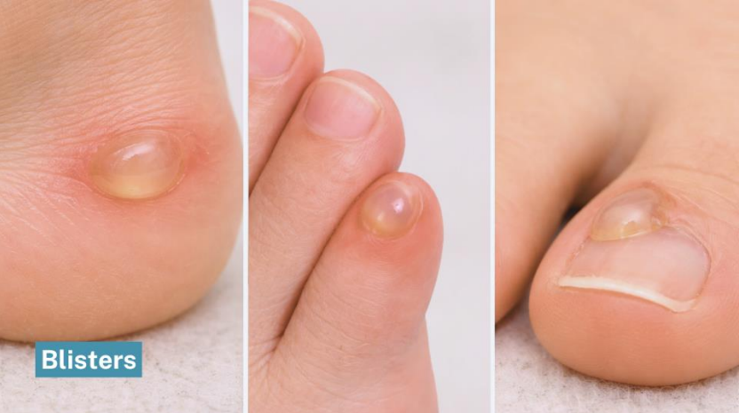 Examples of foot blisters showing small fluid-filled areas on heel and toes