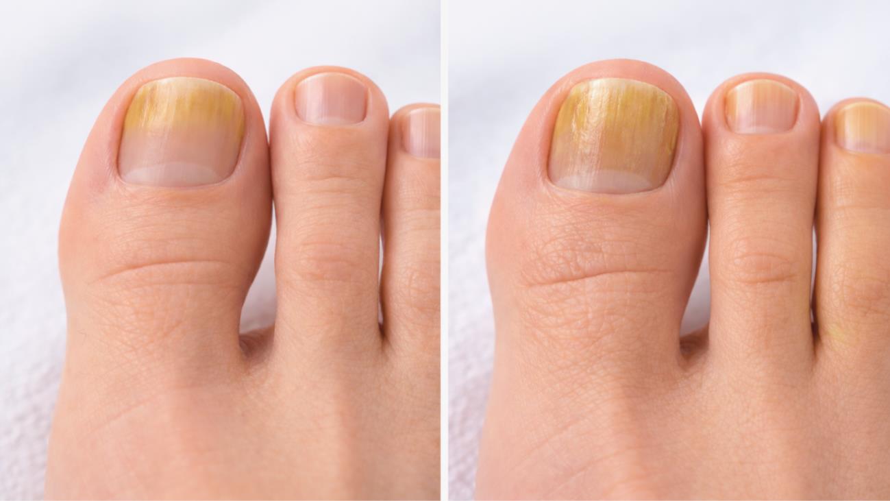 Can Toenail Fungus Go Away On Its Own Podiatrist In New Mexico