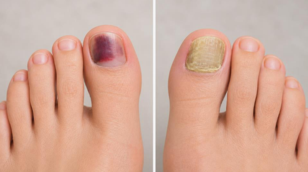 Toenail trauma or fungus comparison showing bruised and thickened toenails