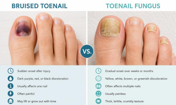 Bruised toenail vs fungus comparison showing different nail discoloration and texture changes