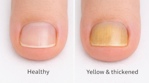 Healthy toenail compared with thick yellow toenail showing nail discoloration
