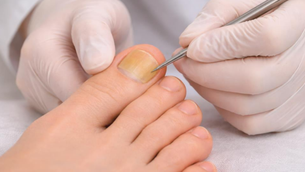 Podiatrist examining yellow toenail discoloration during foot evaluation
